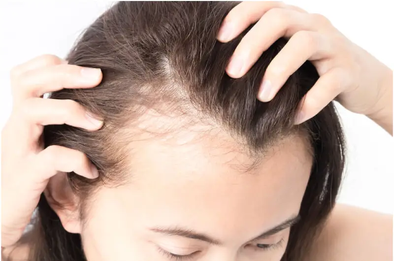 Hair loss women treatment in Istanbul