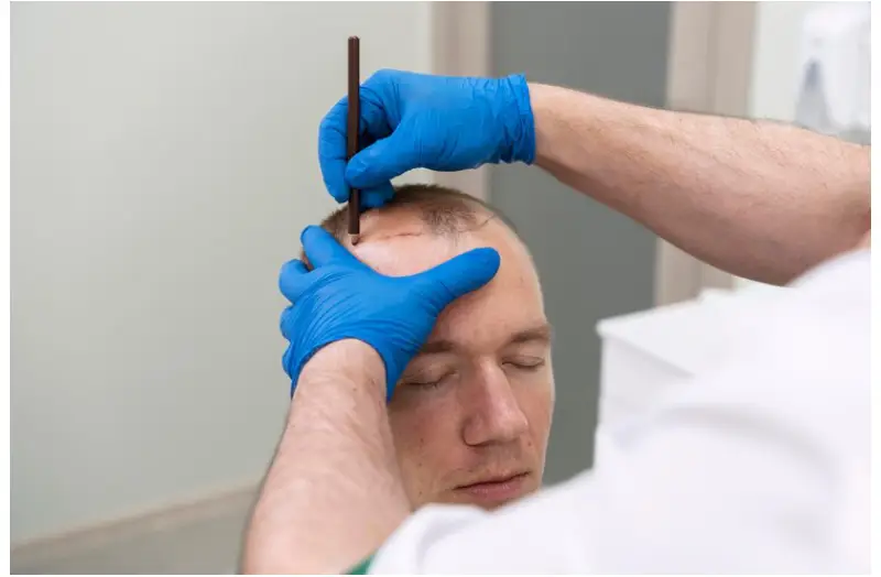 Hair Transplant in Istanbul